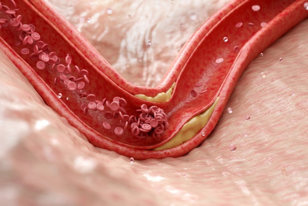 Study: Immune checkpoint landscape of human atherosclerosis and influence of cardiometabolic factors. Image Credit: Piyaset/Shutterstock.com