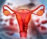 Metabolic imaging detects ovarian cancer subtypes and predicts chemotherapy response