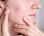 What drives acne relapse? New study explores isotretinoin outcomes