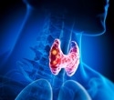 GLP-1RA initiation linked to new thyroid cancer diagnoses