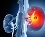 Neoantigen vaccine sparks powerful immune defense against kidney cancer