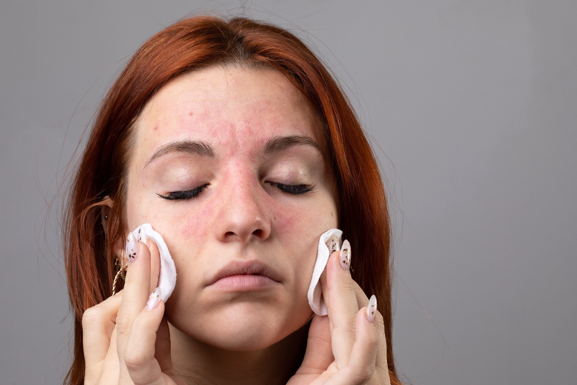 Study: Facets of shame and their impact on quality of life in patients with atopic dermatitis and psoriasis. Image Credit: sruilk / Shutterstock