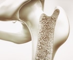 Lipid buildup predicts weaker bones once it passes a critical threshold
