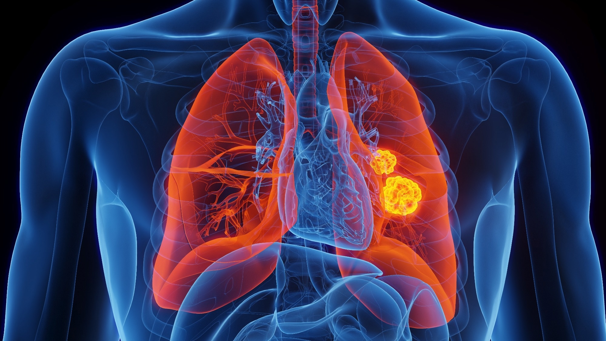Does postoperative plasma IL-6 improve early prediction of infection after pulmonary cancer surgery? A two-centre prospective study. Image Credit: 3dMediSphere / Shutterstock