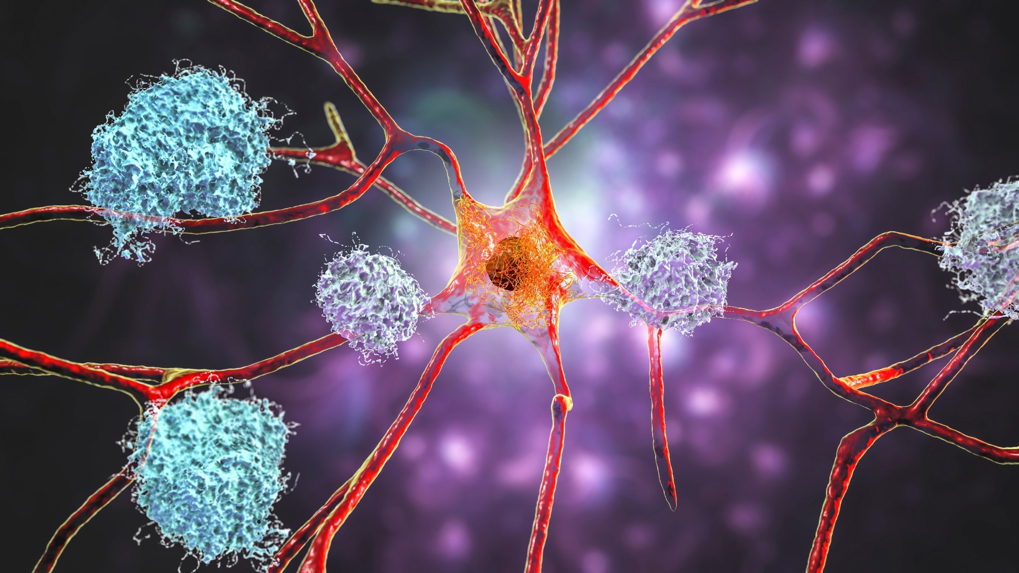 Study: Cell-type-directed network-correcting combination therapy for Alzheimer’s disease. Image Credit: Kateryna Kon / Shutterstock