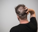 Sugary drinks increase hair loss risk, scientists warn