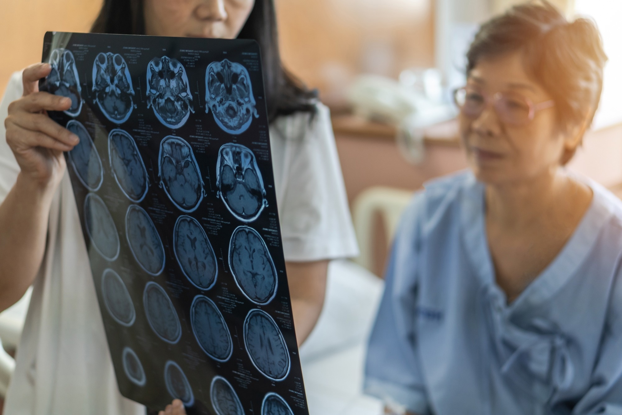 medical doctor diagnosing elderly ageing patient neurodegenerative illness problem seeing Magnetic Resonance Imaging (MRI) film