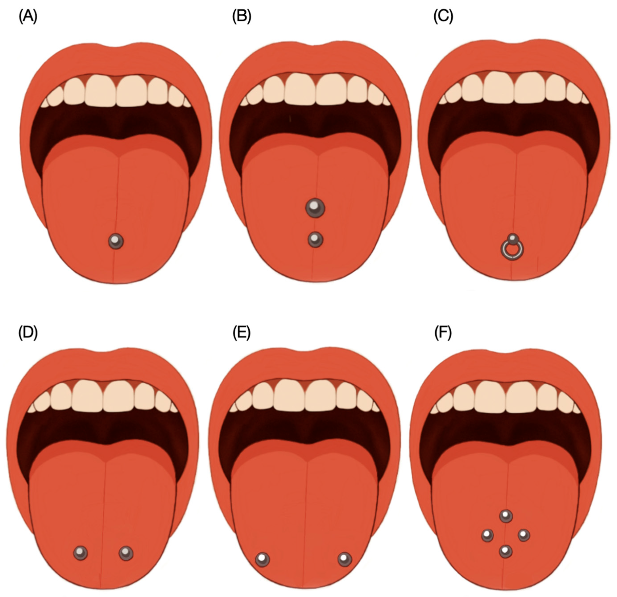 Schematic diagram illustrating the most common sites for tongue piercings. (A) Single middle tongue; (B) double piercing in midline; (C) ring piercing; (D,E) double piercing horizontally and (F) multiple piercing usually involving two or more piercings arranged in a row or symmetrically on either side of the midline.