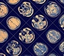 Blood and brain biomarkers transform how doctors confirm Alzheimer’s disease