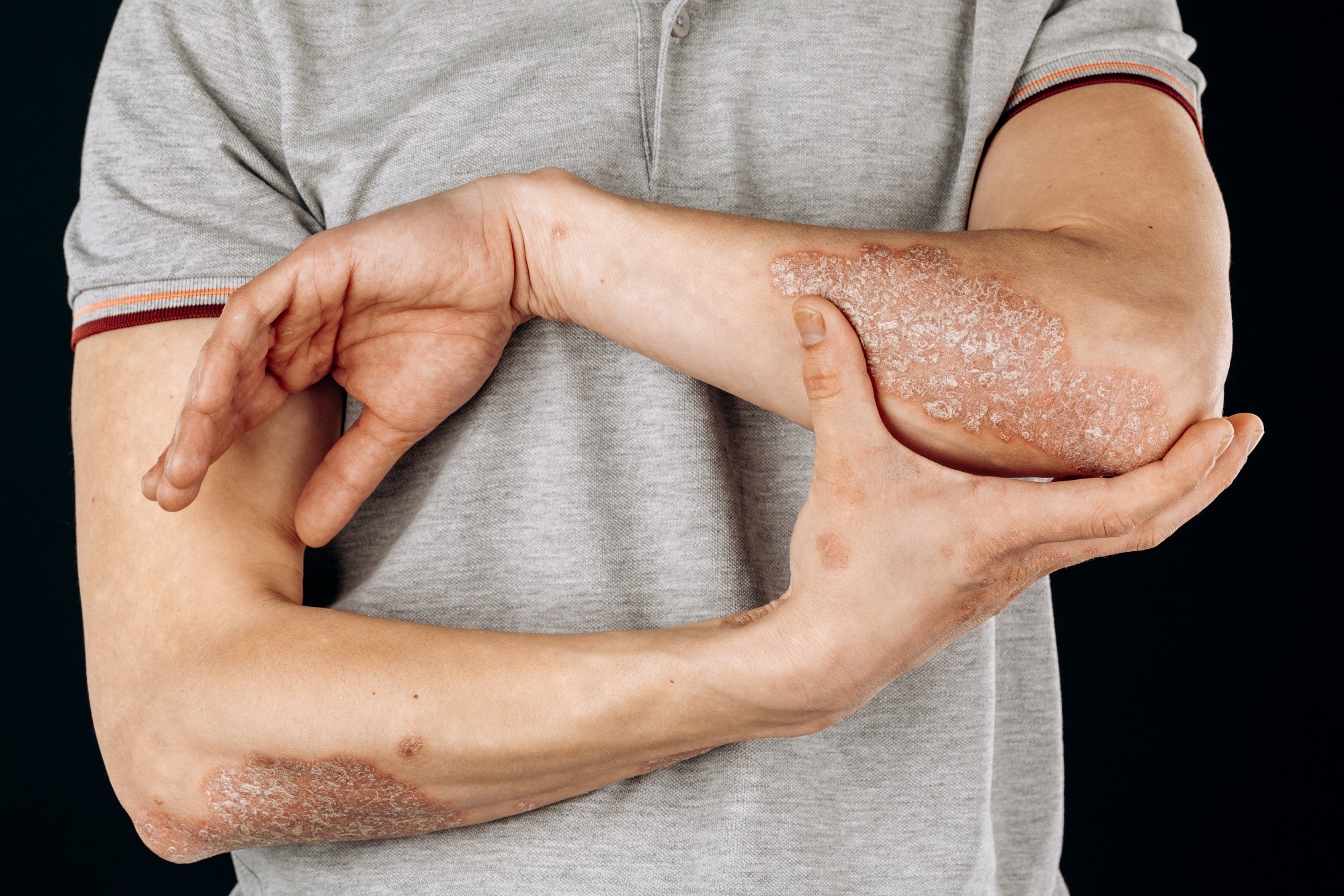 Study: Causal Relationships Between Popular Diets (Low-Calorie, Vegetarian, and Gluten-Free Diets) and Inflammatory Skin Diseases: A Mendelian Randomization Study. Image Credit: Fuss Sergey / Shuttertock