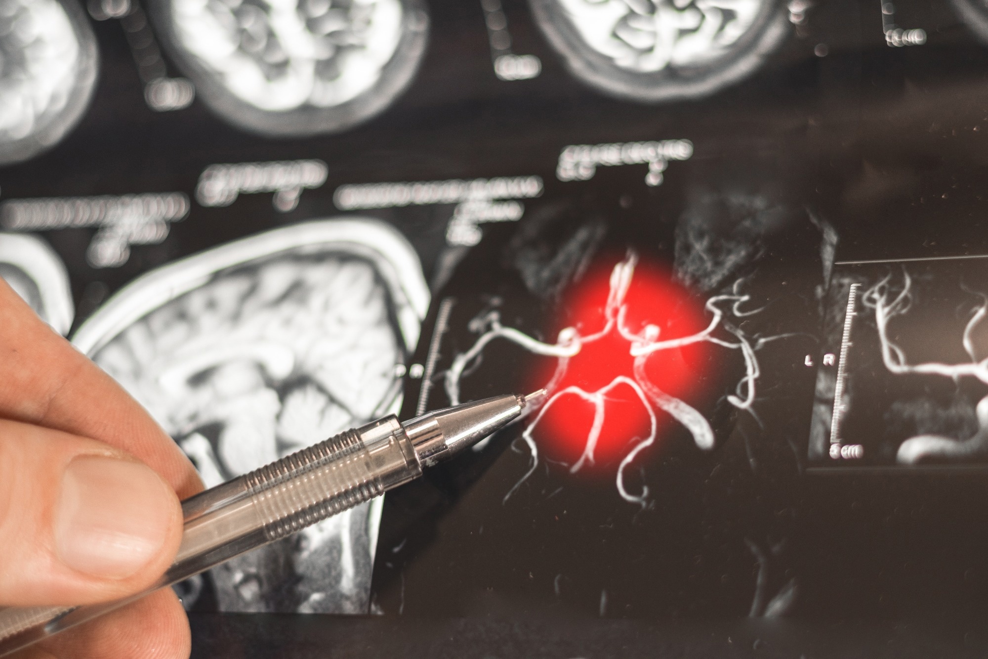 Study: The microbiota–gut–brain axis in mild cognitive impairment and Alzheimer