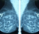 Cleveland Clinic reports promising results for breast cancer vaccine from final Phase 1 data