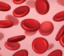 Repurposed Alzheimer’s medication offers low-cost hope for sickle cell anemia