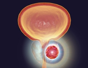 PSA-based tool improves decision making for prostate cancer screening and treatment