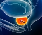 New trial aims to improve both survival and quality of life for men with advanced prostate cancer
