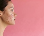 Acne drug not linked to increased suicide risk