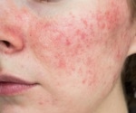 Researchers work to defeat acne by understanding it better on a molecular level