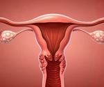 UCSF research maps over 600 conditions linked to endometriosis