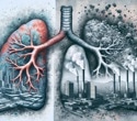 Air pollution and immune changes could trigger autoimmune conditions